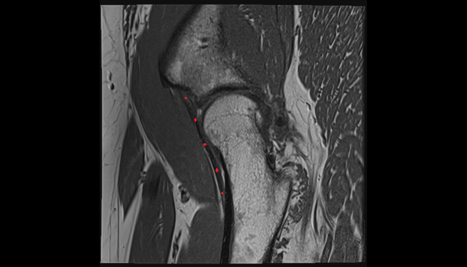 Iliofemoral ligament  MRI sag anatomy image-img-00000-00000_00001