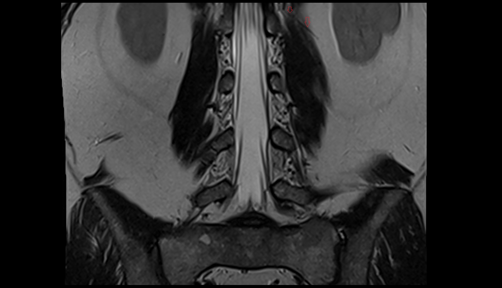 Iliohypogastric nerve 1