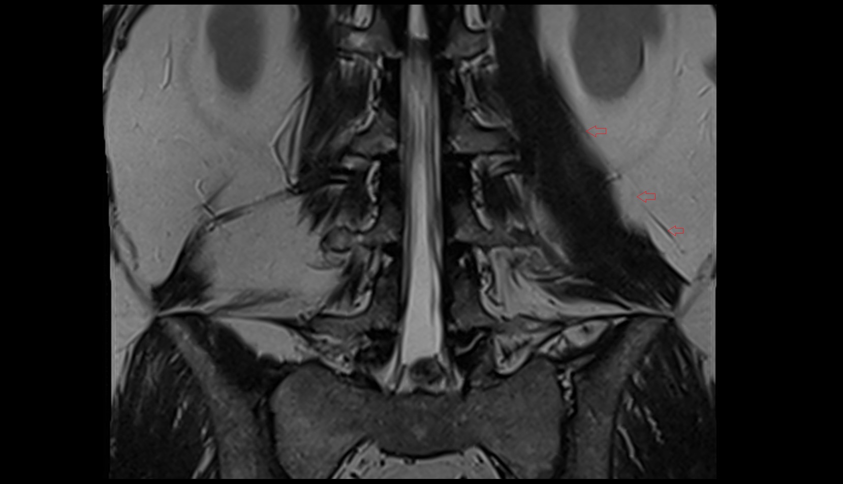 Iliohypogastric nerve MRI coronal image