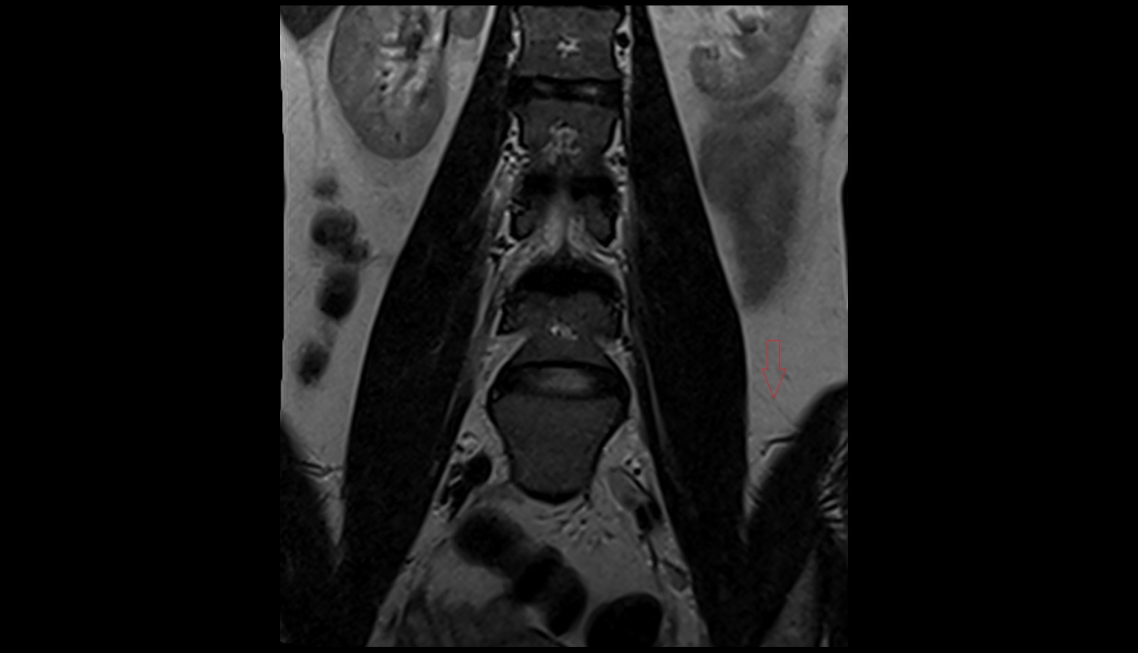 Ilioinguinal nerve MRI CORONAL IMAGE