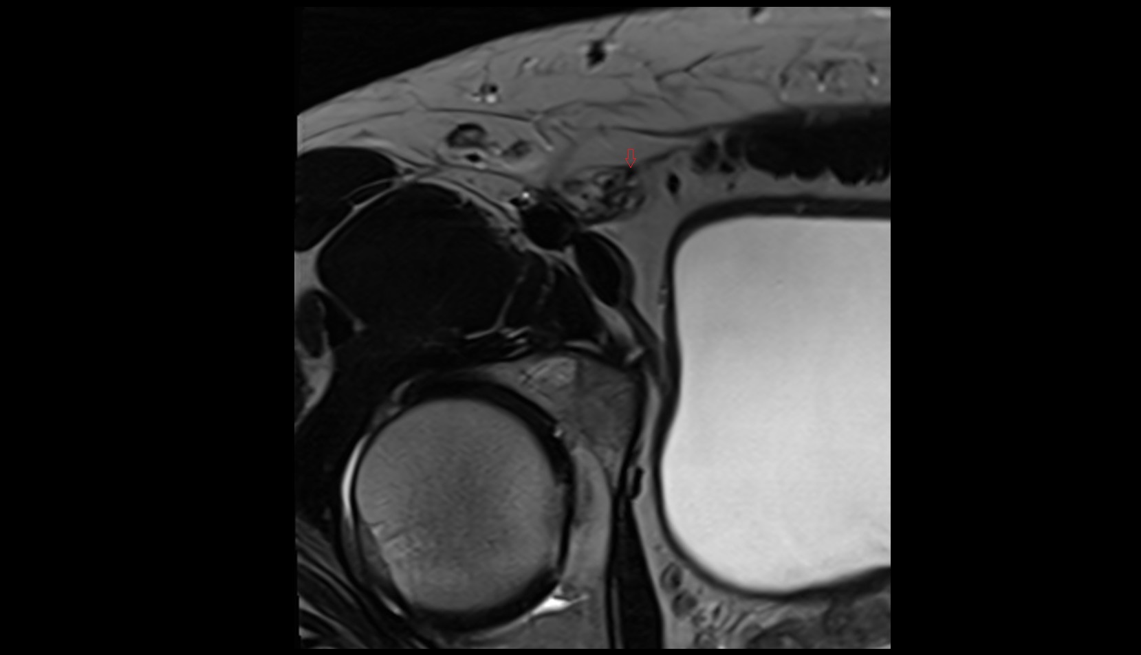 Ilioinguinal nerve MRI CORONAL IMAGE  2