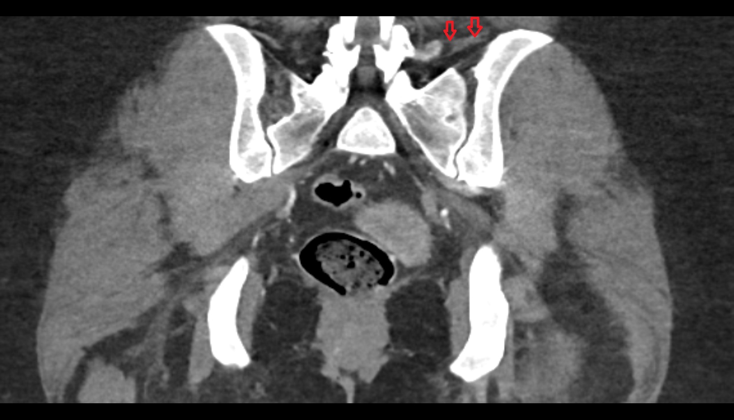Iliolumbar ligament ct coronal  anatomy  image-img-00000-00000