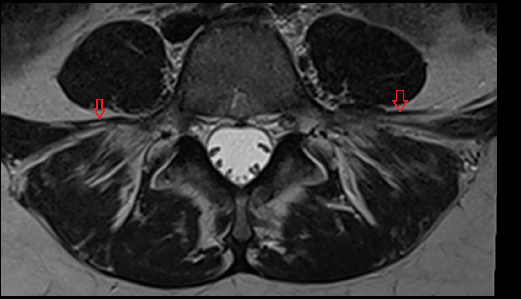Iliolumbar ligament mri axial image