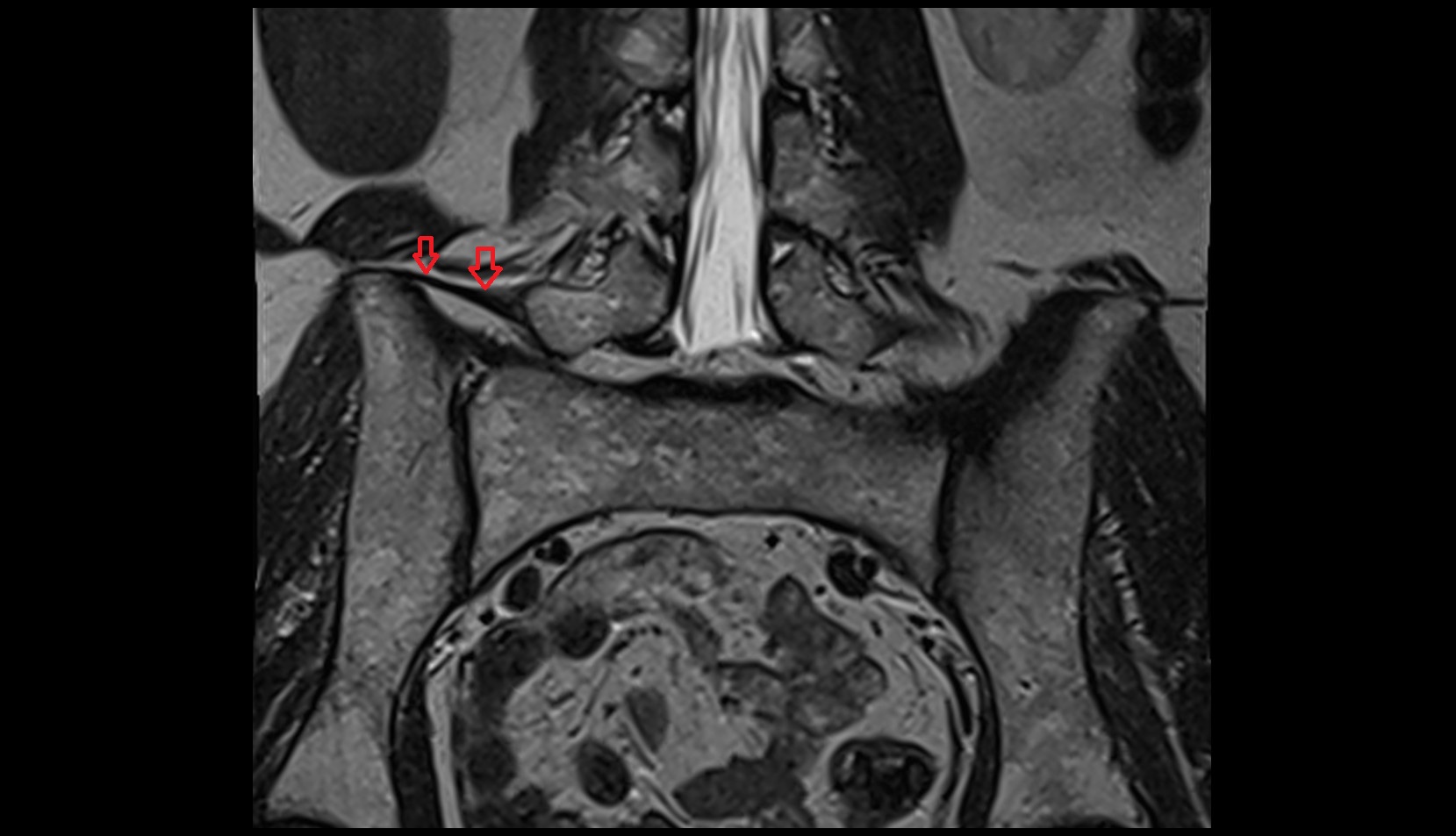 Iliolumbar ligament mri coronal image