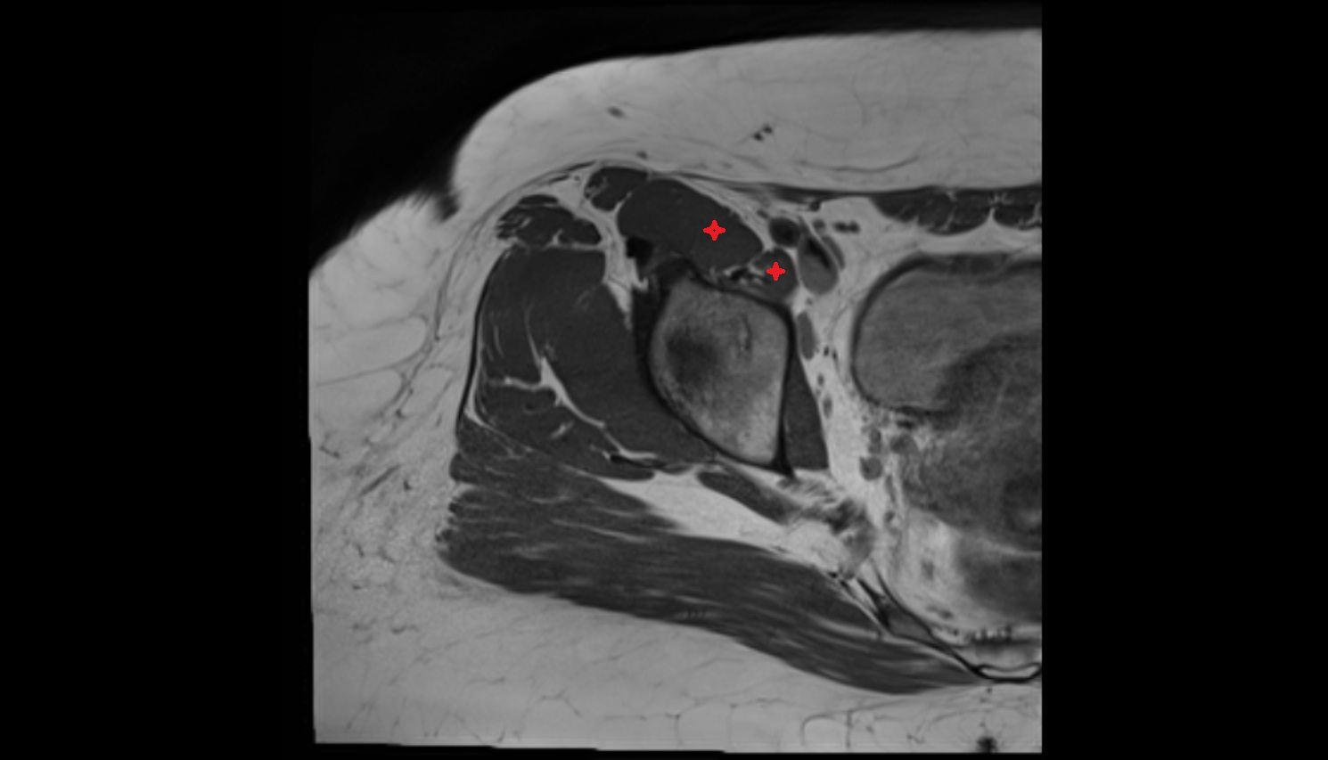 Iliopsoas muscle  MRI axial  anatomy image-img-00000-00000