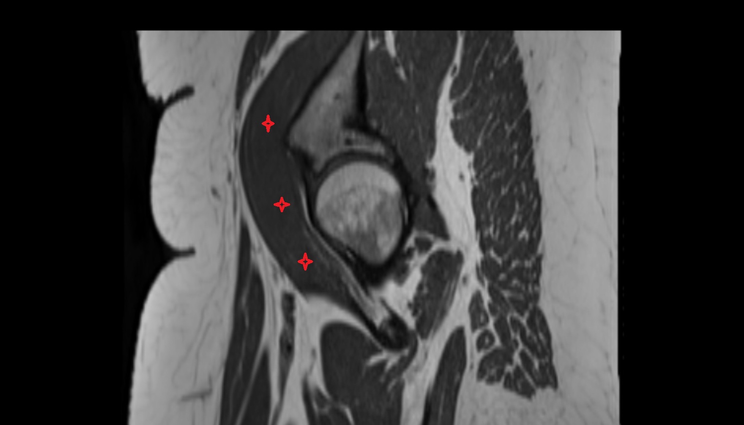 Iliopsoas muscle  MRI sagittal  anatomy image-img-00000-00000