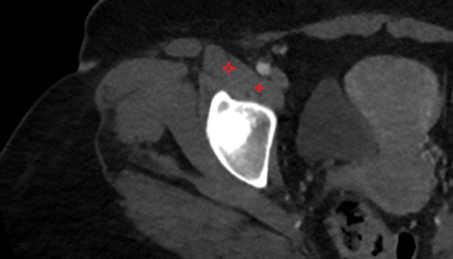 Iliopsoas muscle  ct  axial  anatomy image-img-00000-00000
