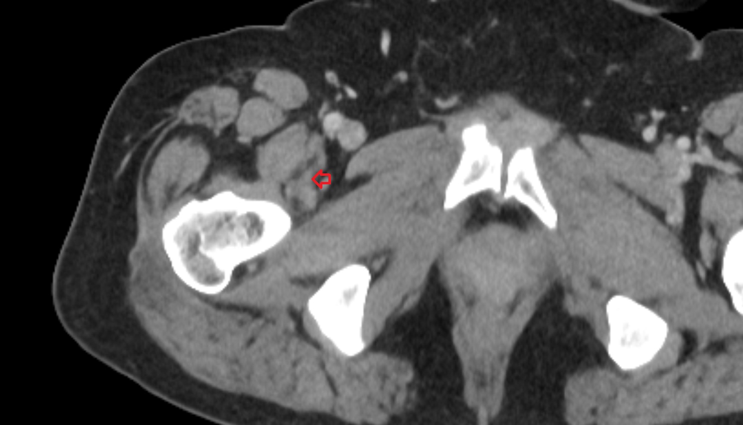 Iliopsoas tendon CT axial  image anatomy  image-img-00000-00000