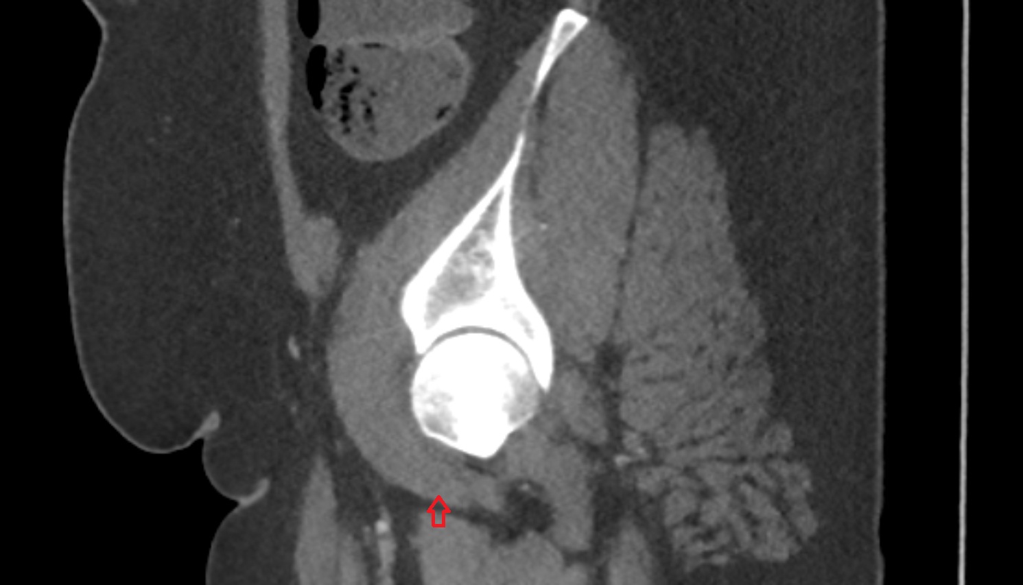 Iliopsoas tendon CT sag  image anatomy  image-img-00000-00000