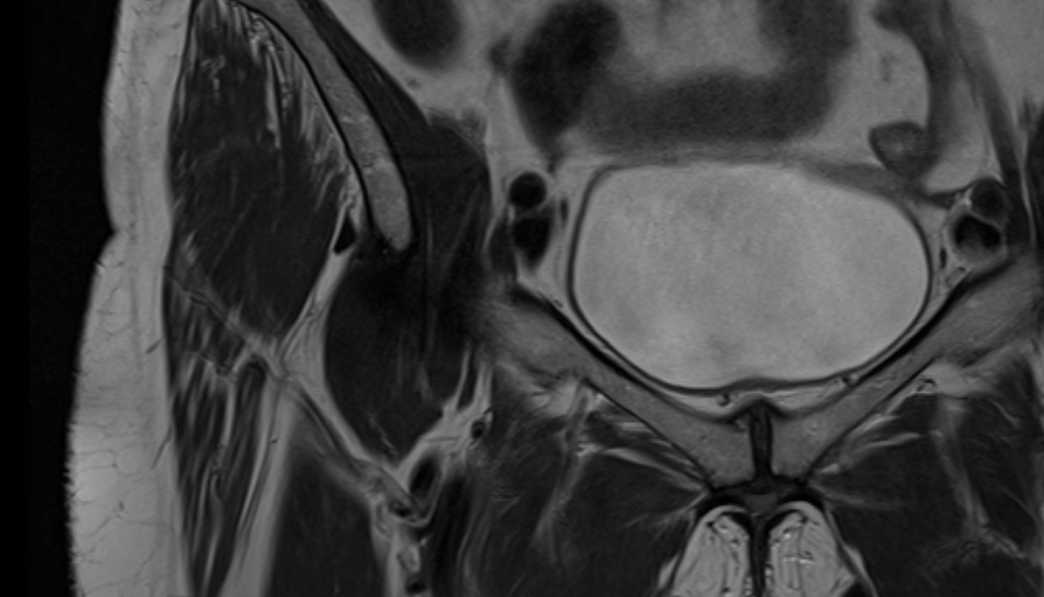 Iliopsoas tendon MRI coronal  image anatomy  image-img-00000-00000