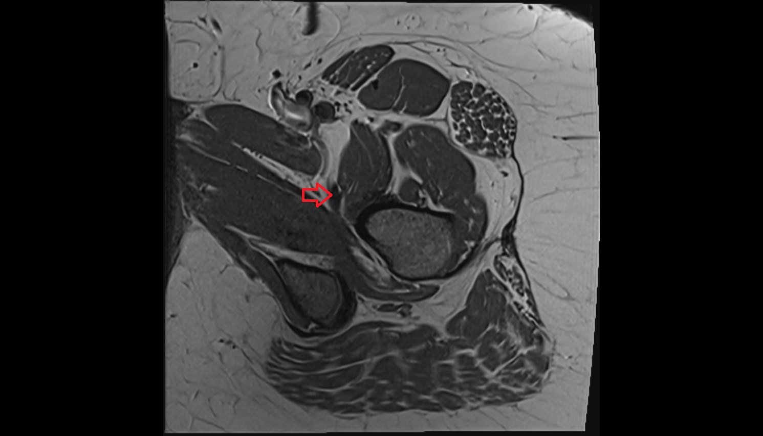 Iliopsoas tendon  mri axial  image anatomy  image-img-00000-00000