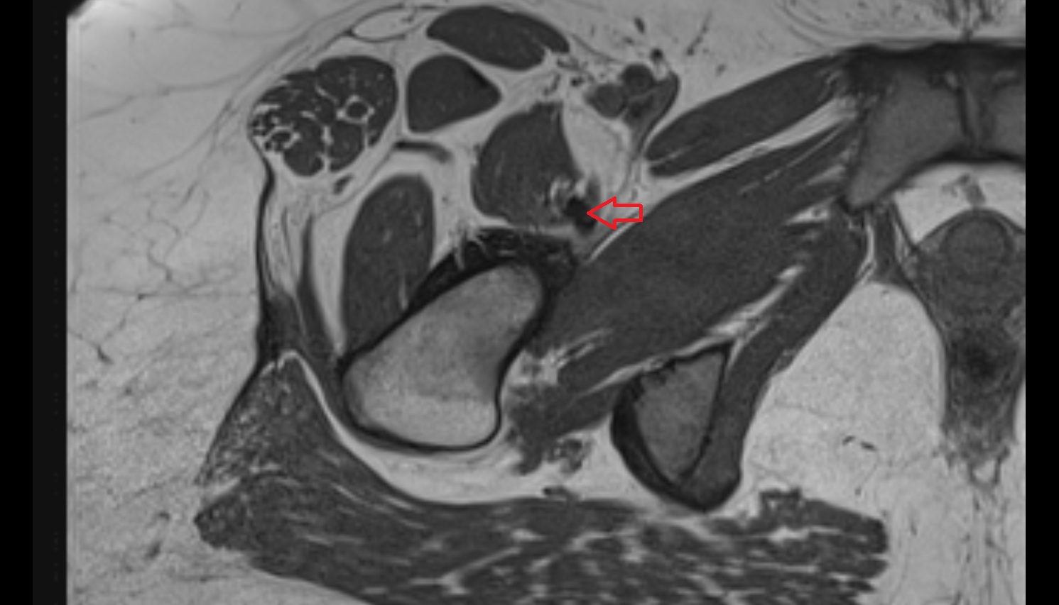 Iliopsoas tendon  mri axial  image anatomy  image-img-00000-00000_00002