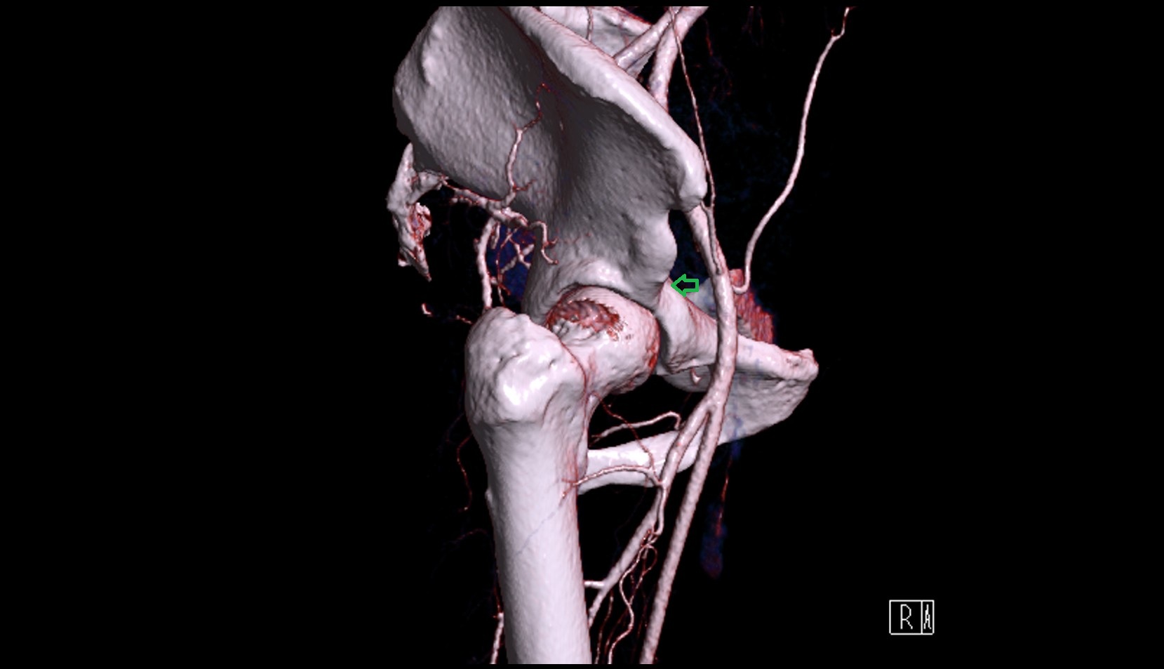 Iliopubic eminence 3D CT VRT anatomy  image