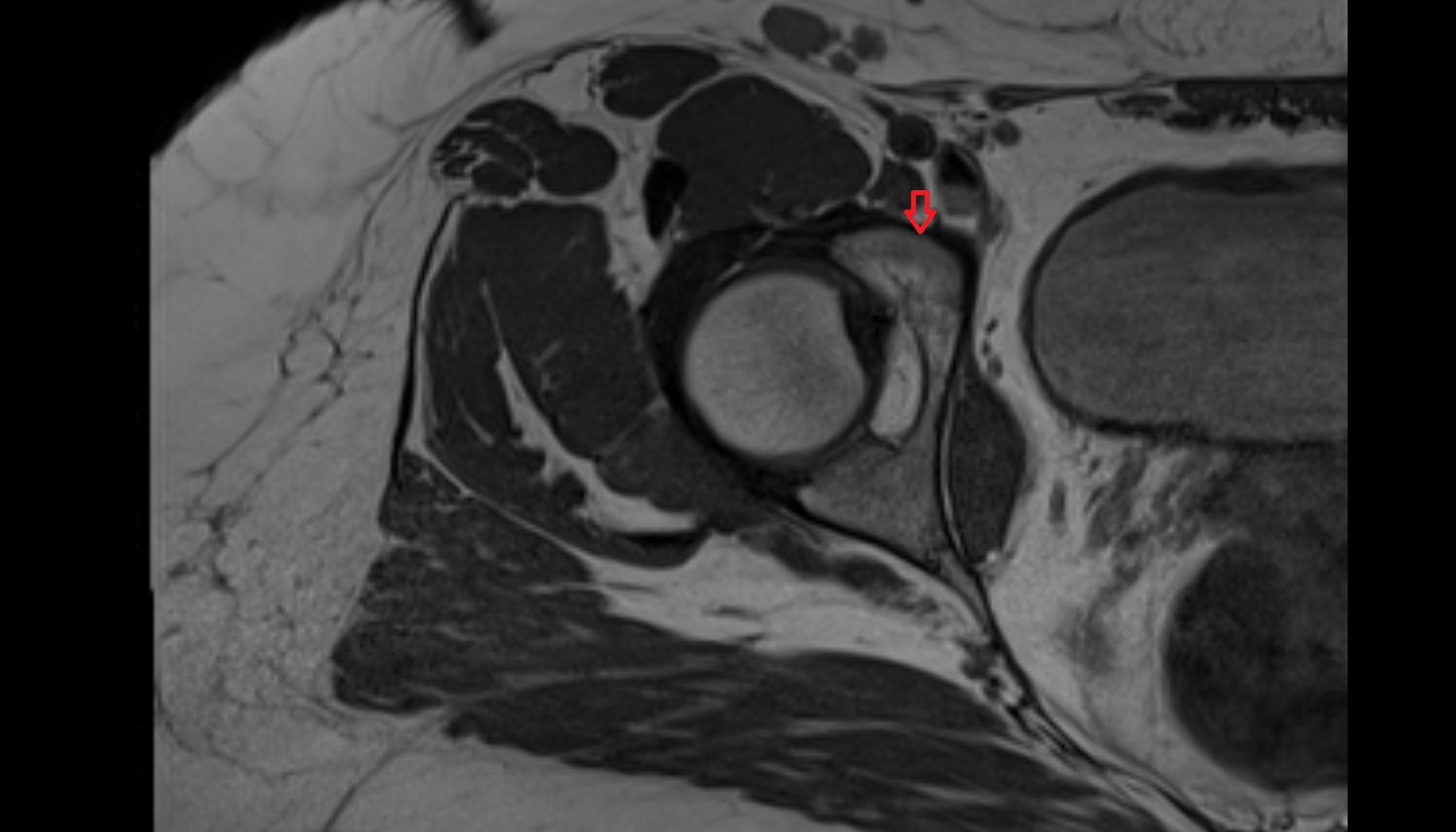 Iliopubic eminence  MRI  axial  anatomy  image-img-00000-00000