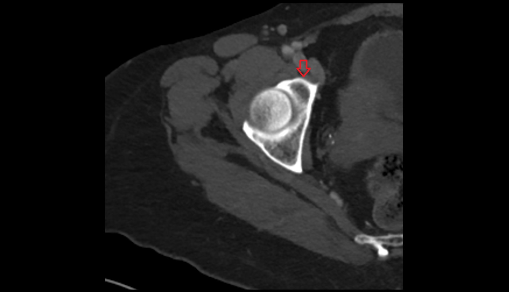 Iliopubic eminence ct axial image