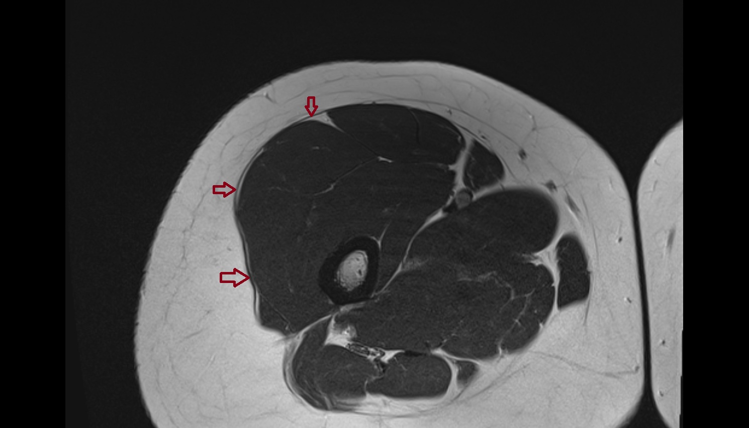 Iliotibial tract  MRI axial  anatomy  image-img-00000-00000