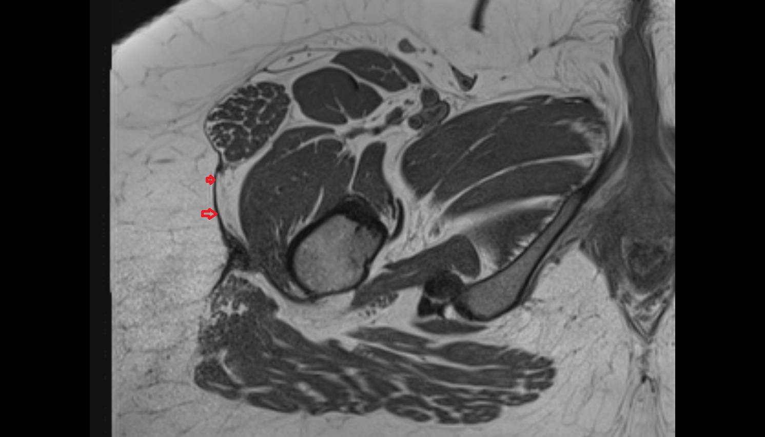 Iliotibial tract  MRI axial  anatomy  image-img-00000-00000_00001