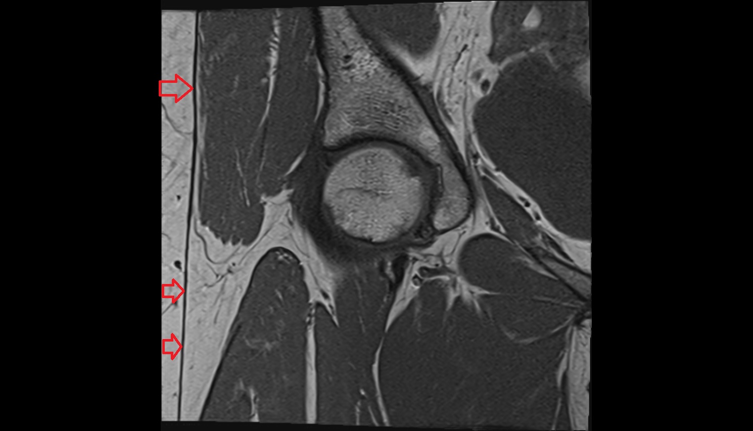 Iliotibial tract  MRI coronal anatomy image-img-00000-00000