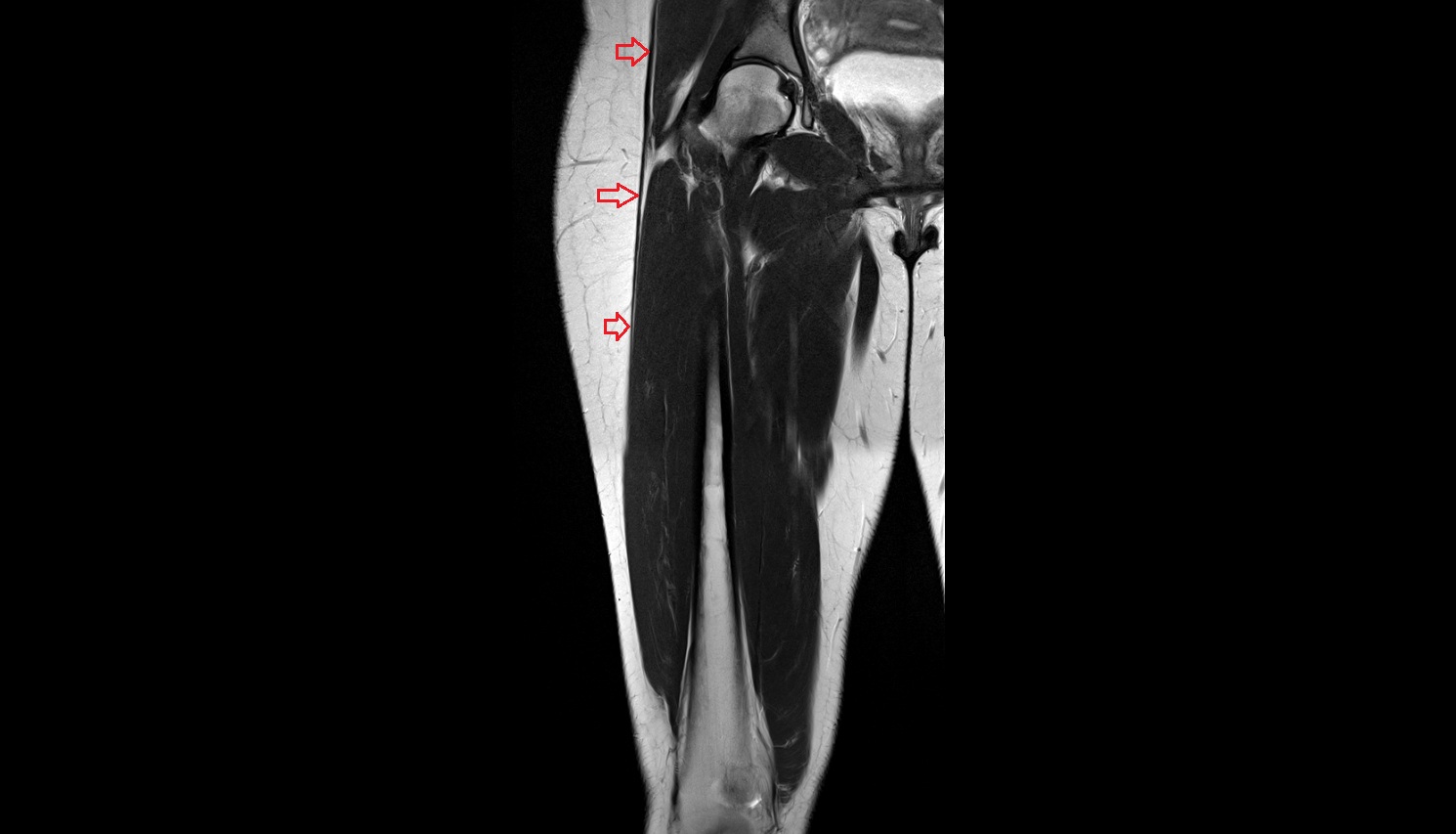 Iliotibial tract  MRI coronal anatomy image-img-00000-00000_00001