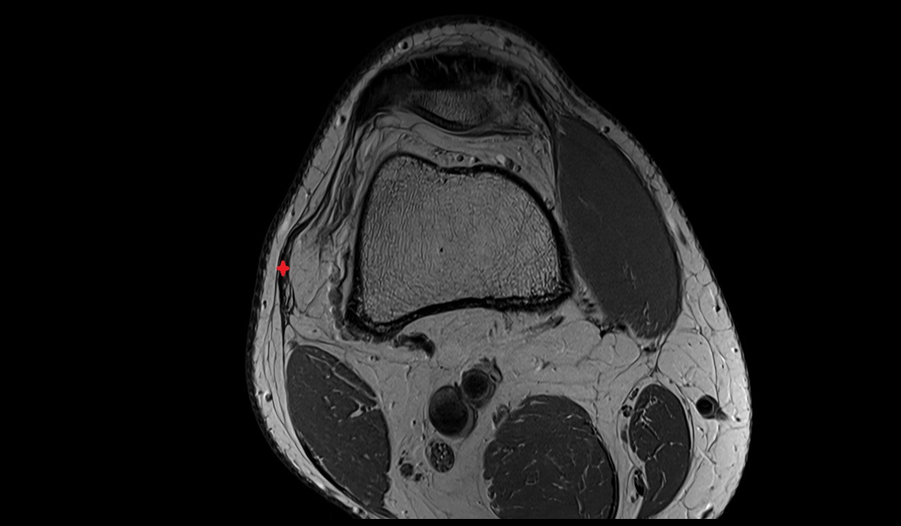 Iliotibial tract anatomy image