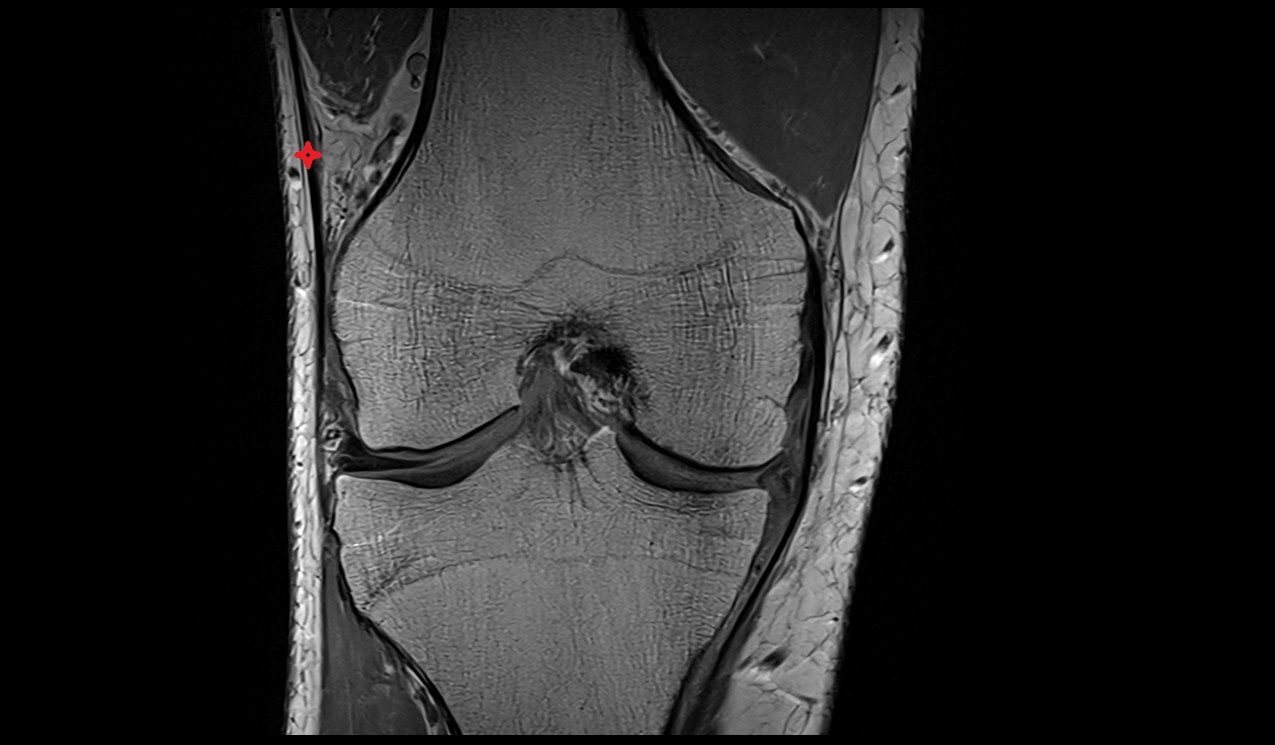 Iliotibial tract anatomy image mri 3t