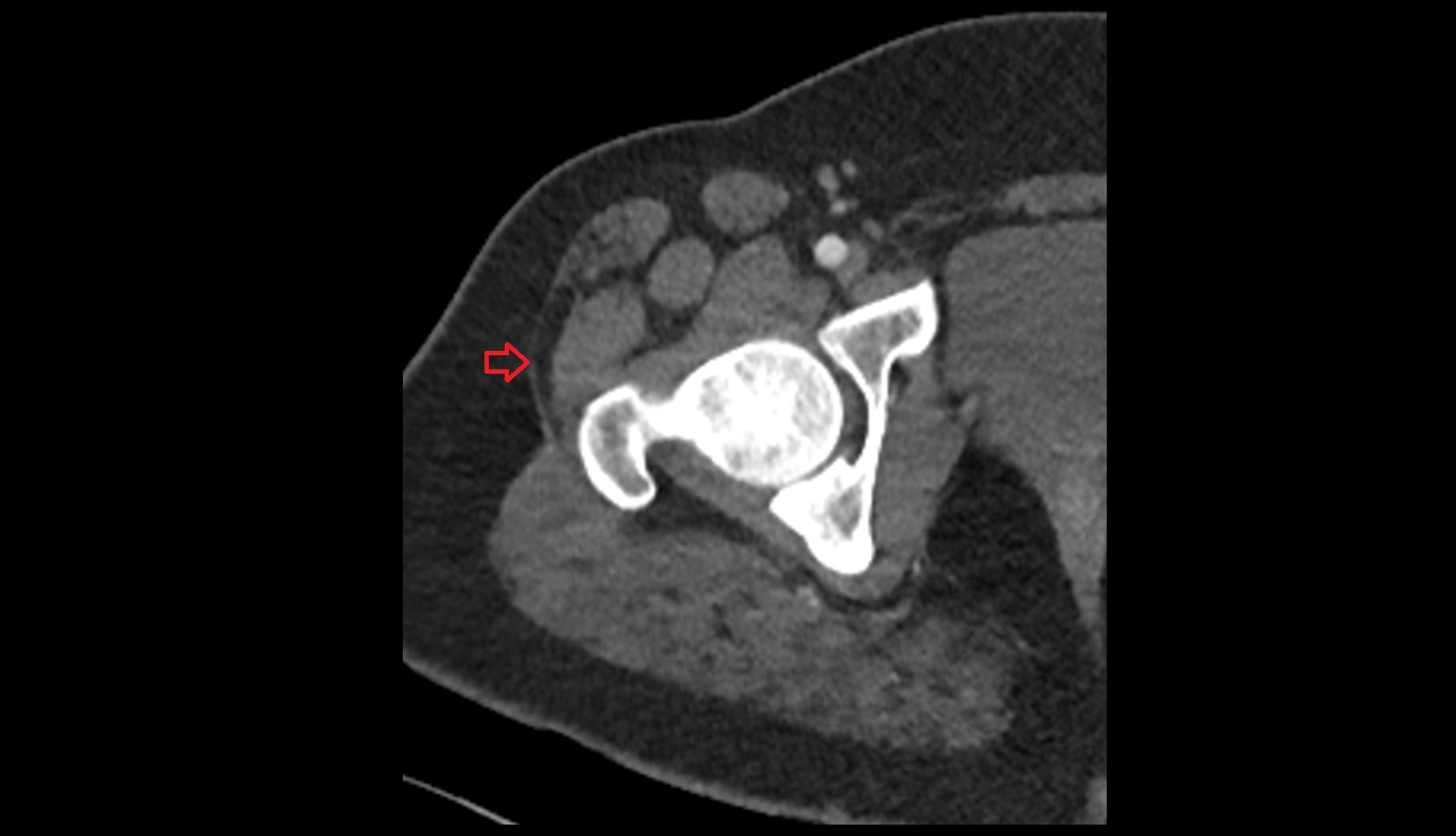 Iliotibial tract ct axial image