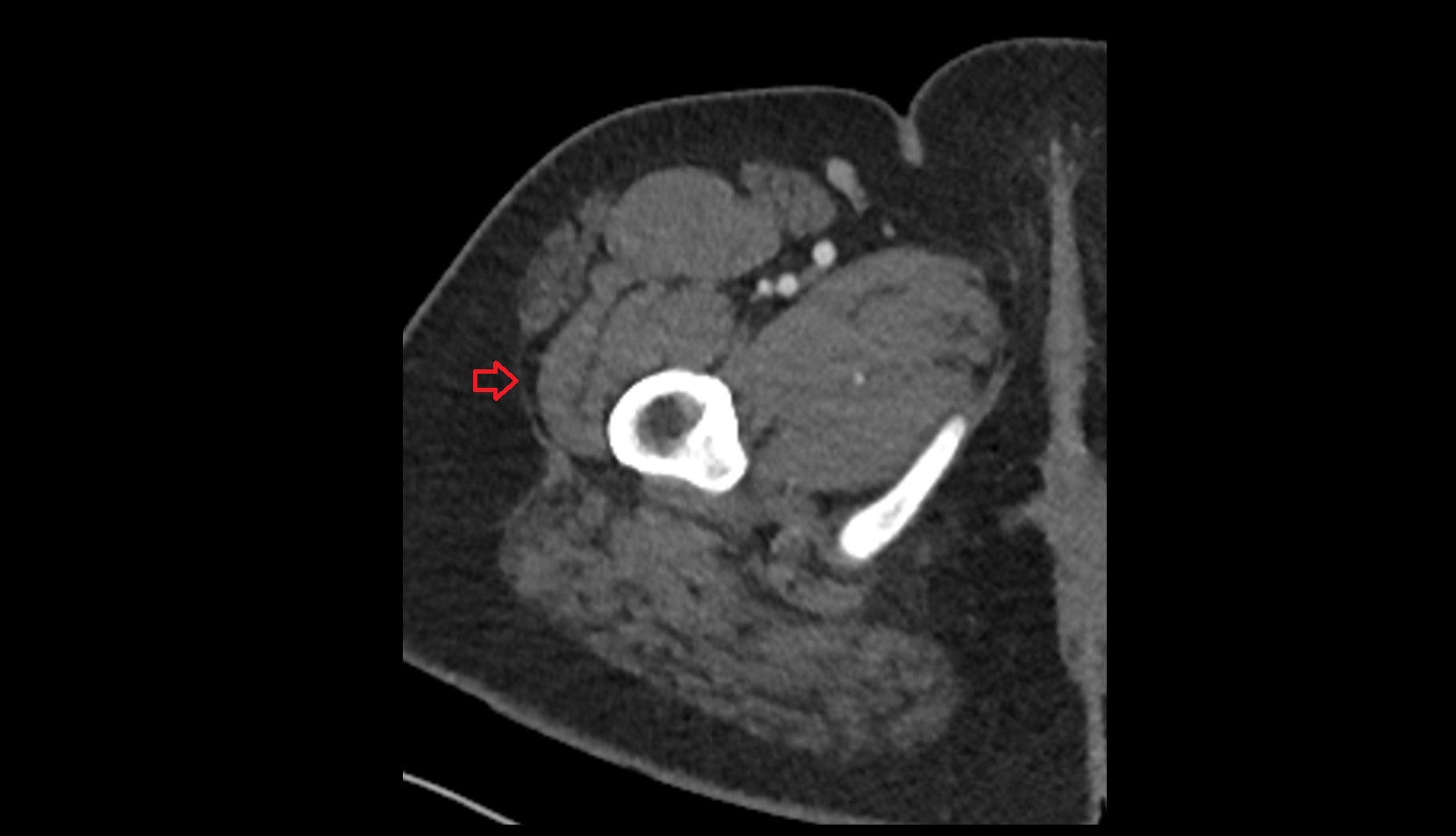 Iliotibial tract ct axial image 1