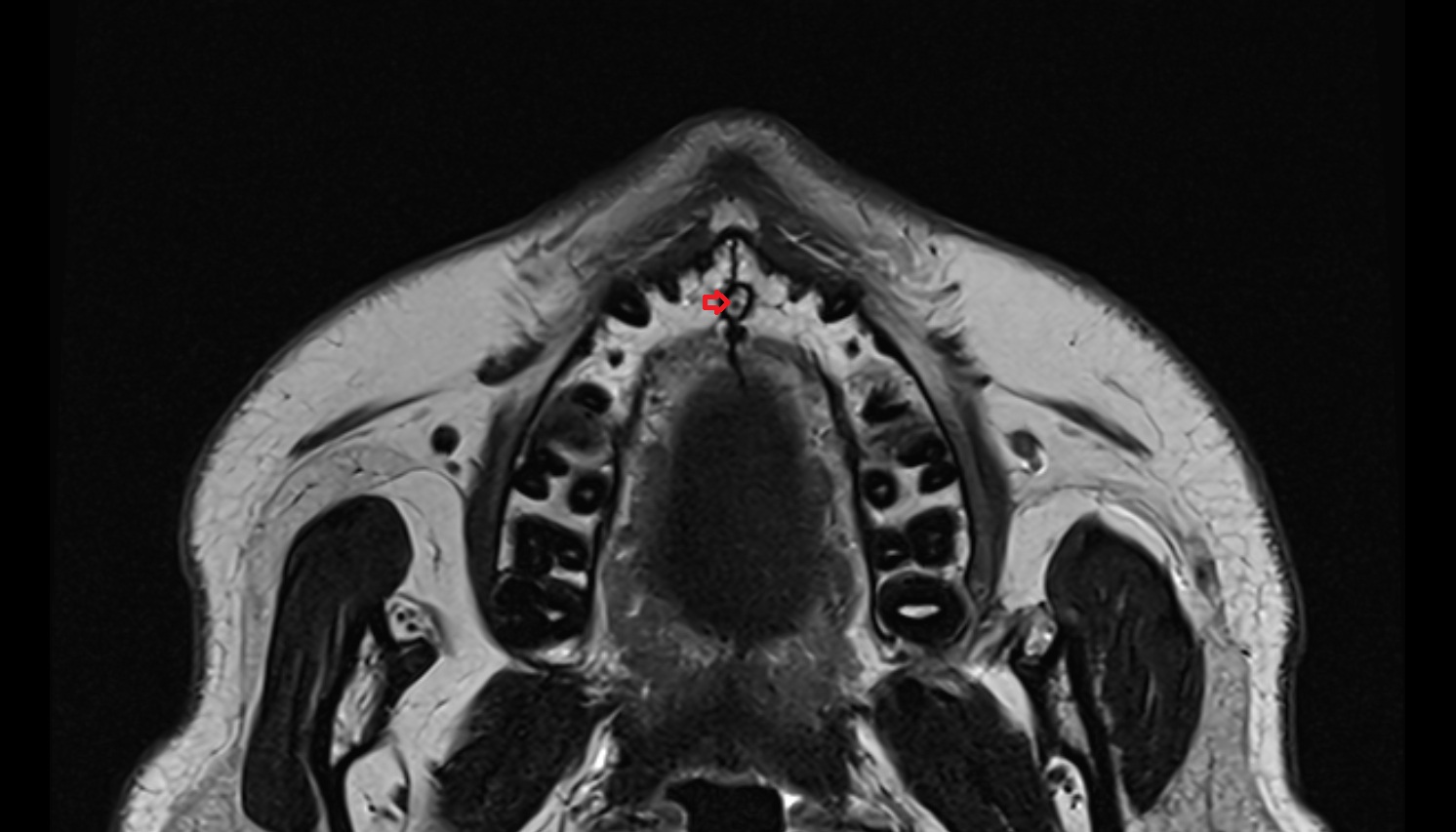 Incisive duct mri axial image -img-00000-00000
