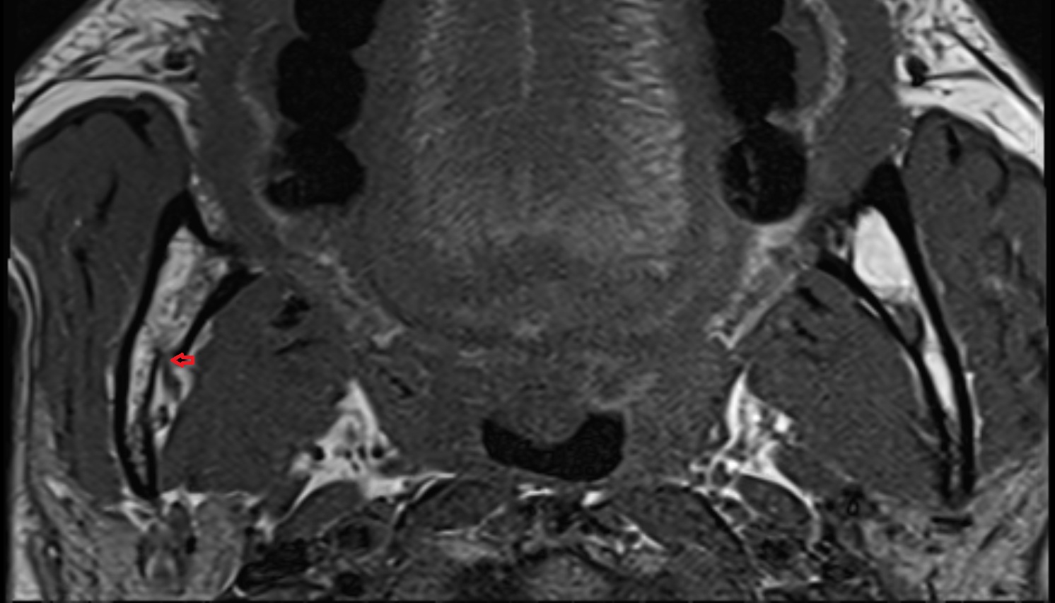 Inferior Alveolar Foramen (Mandibular Foramen)  mri axial  image -img-00000-00000