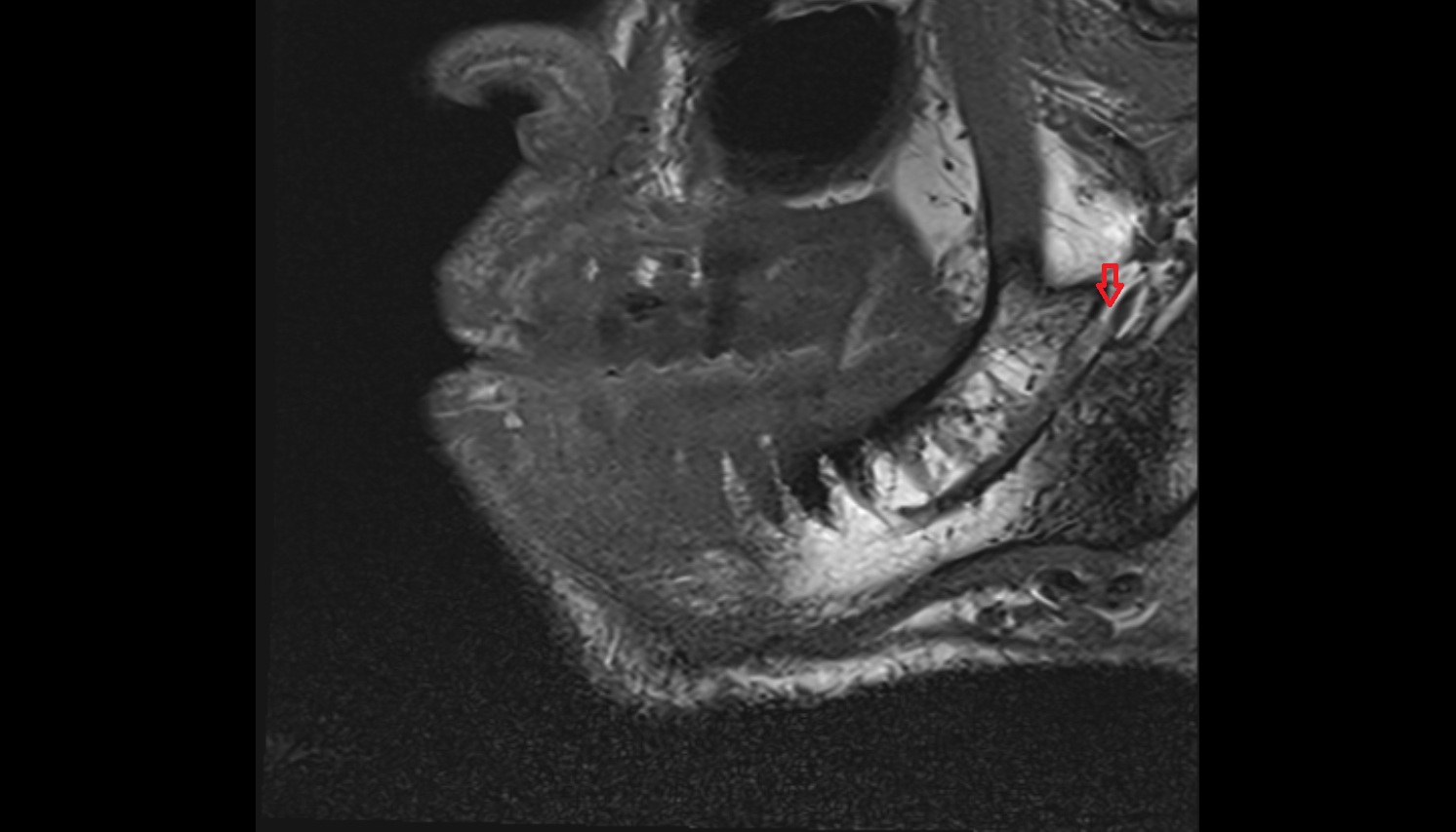 Inferior Alveolar Foramen (Mandibular Foramen)  mri sag  image -img-00000-00000