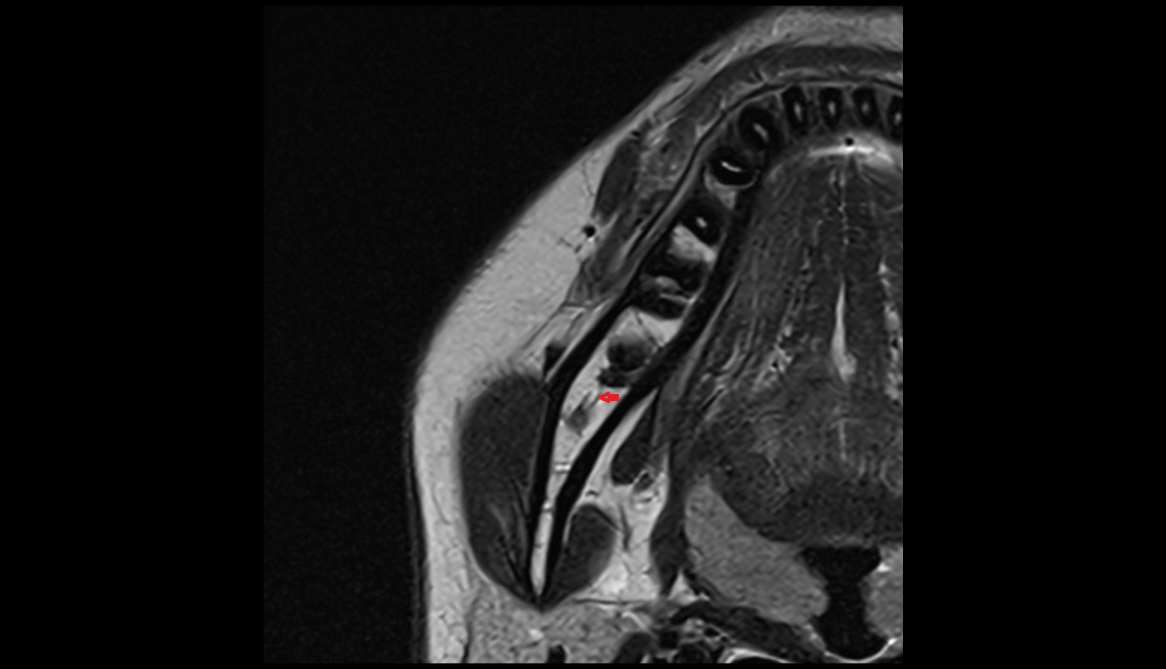 Inferior Alveolar Nerve mri axial image