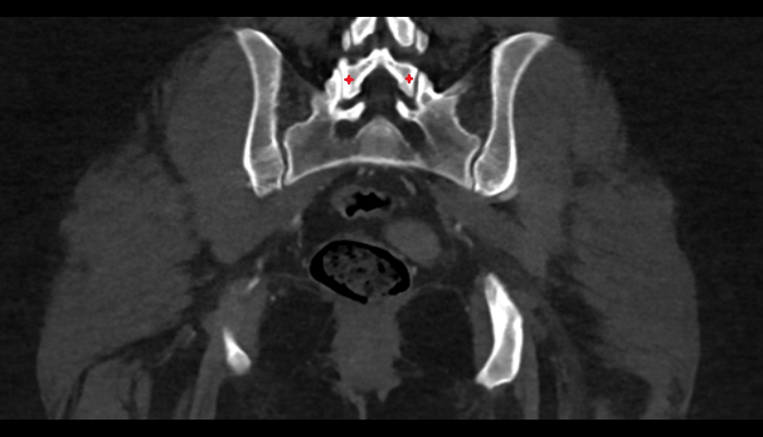 Inferior Articular Process of L5 Vertebra ct coronal  anatomy  image-img-00000-00000