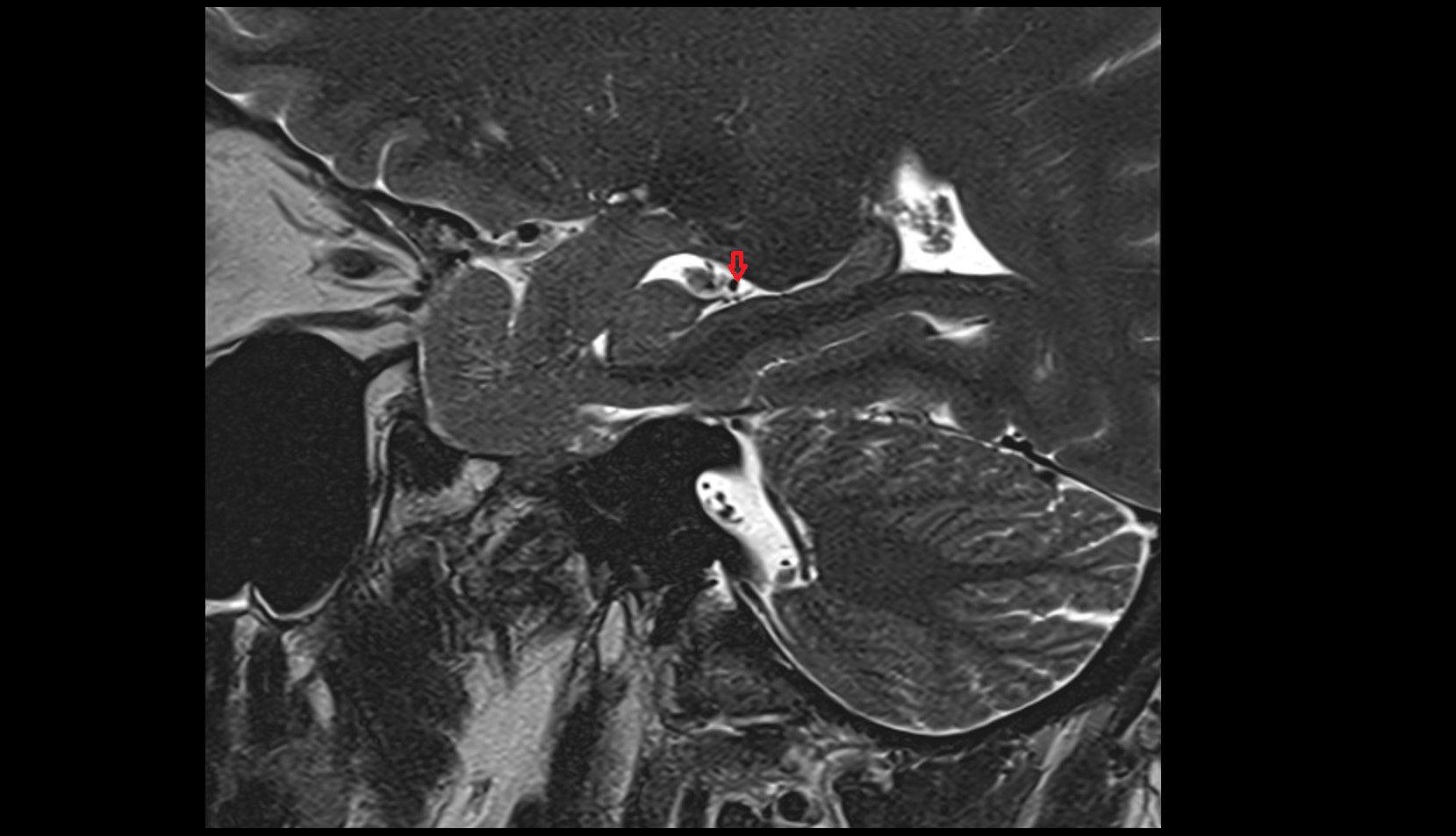 Inferior Choroidal Vein