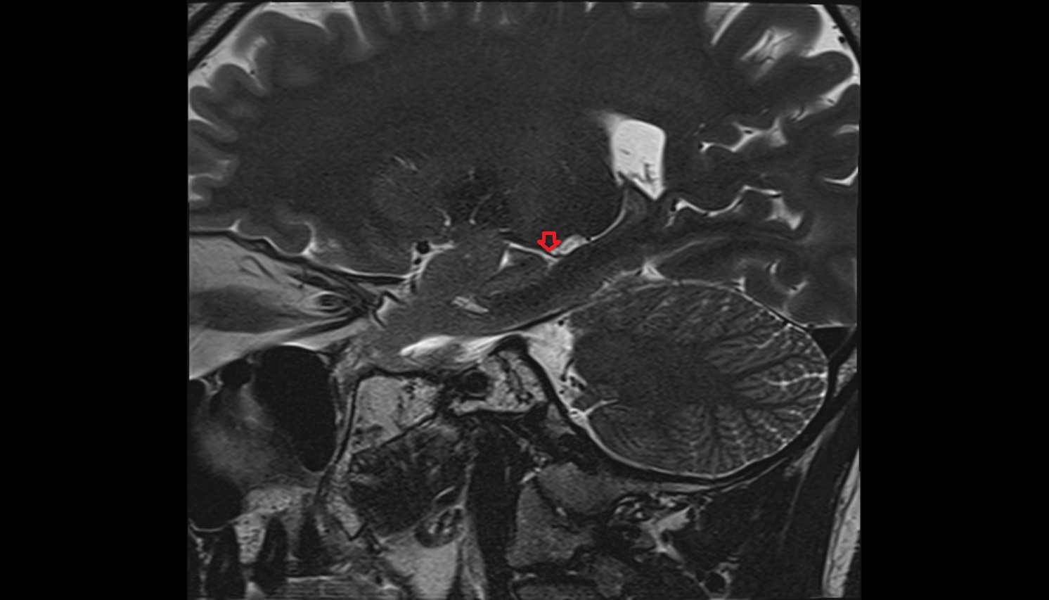 Inferior Choroidal Vein mri sagittal  image -img-00000-00000