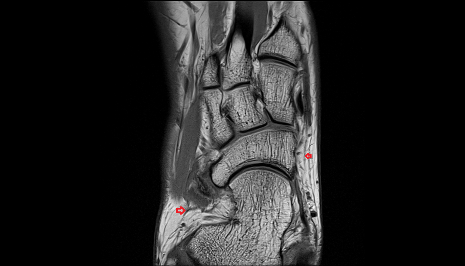 Inferior Extensor Retinaculum axial  cross sectional anatomy 3T MRI AI enhanced radiology image-img-00000-00000_00001
