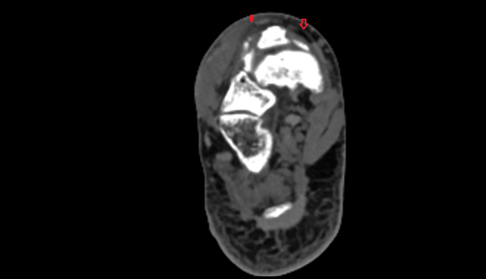 Inferior Extensor Retinaculum ct axial