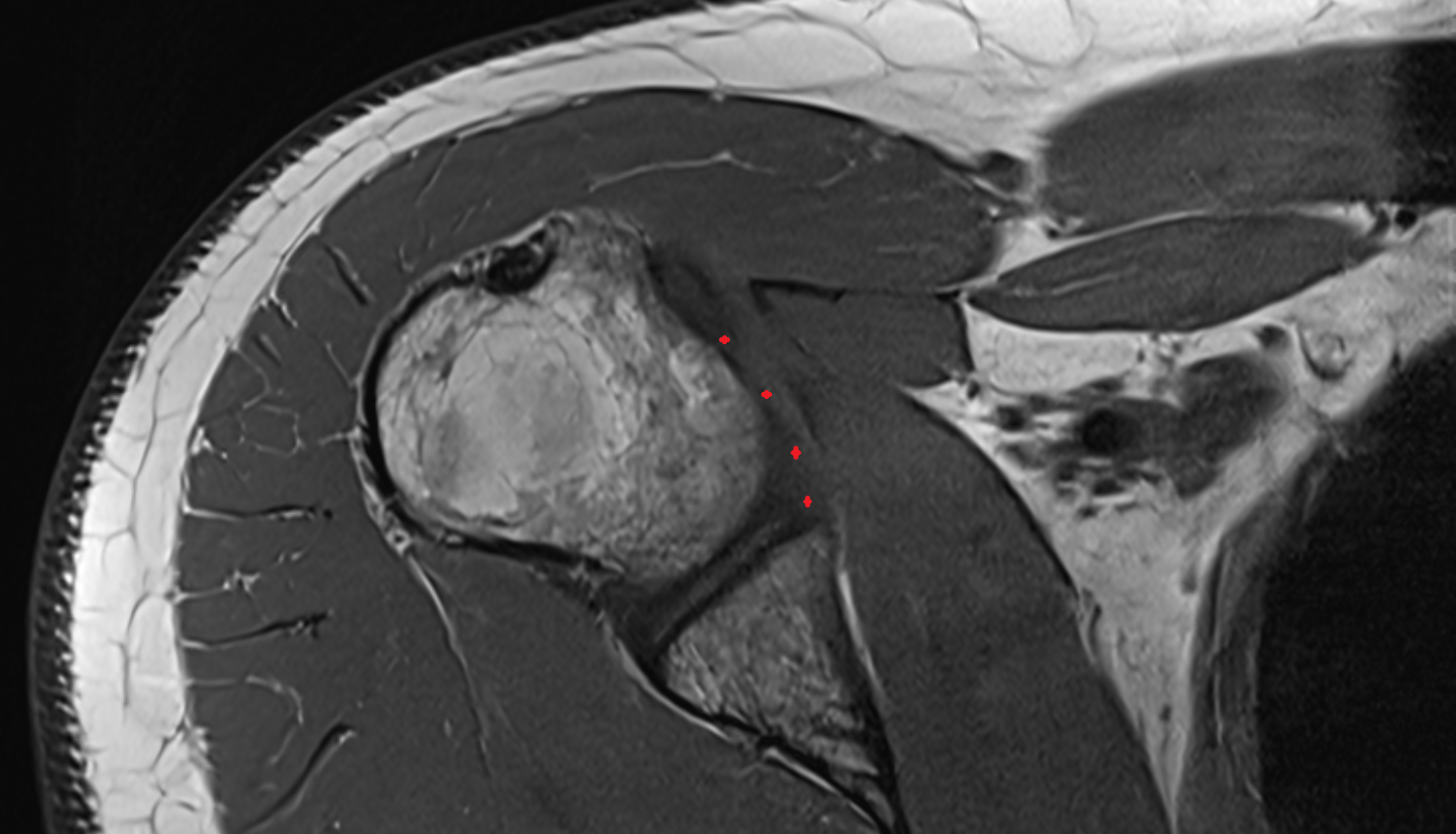 Inferior Glenohumeral Ligament (IGHL)  axial cross sectional anatomy 3T MRI AI enhanced radiology image-img-00000-00000