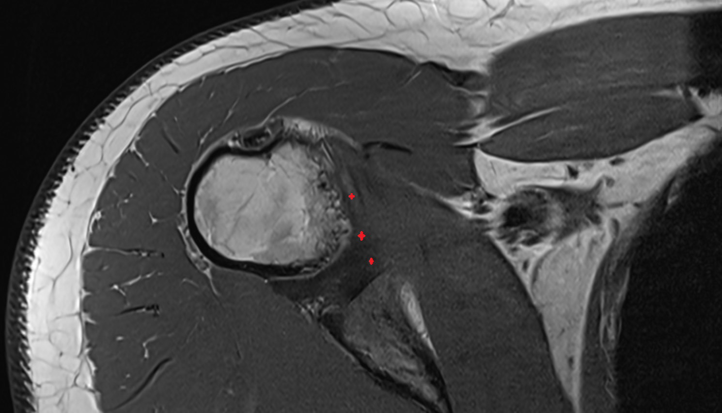 Inferior Glenohumeral Ligament (IGHL) axial cross sectional anatomy 3T MRI AI enhanced radiology image-img-00000-00000_00001