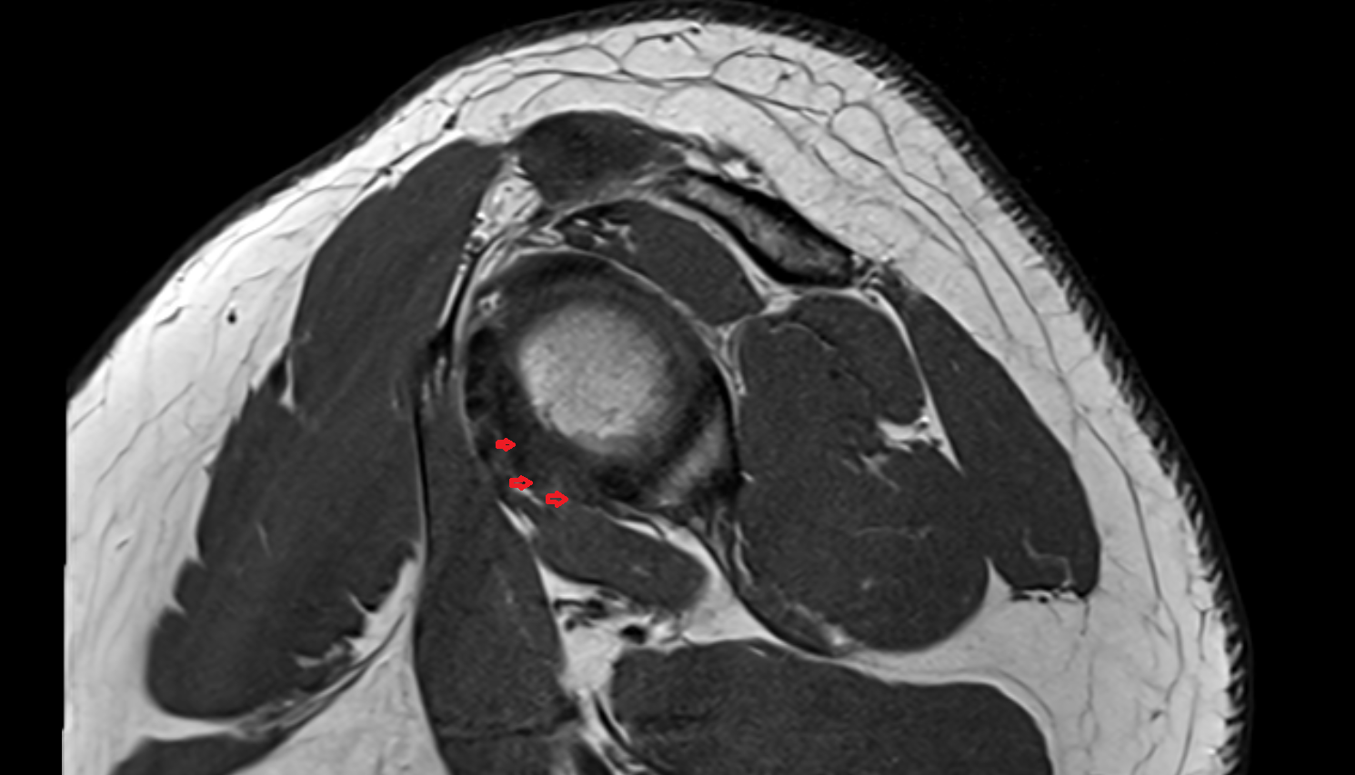 Inferior Glenohumeral Ligament (IGHL)  sagittal cross sectional anatomy 3T MRI AI enhanced radiology image-img-00000-00000