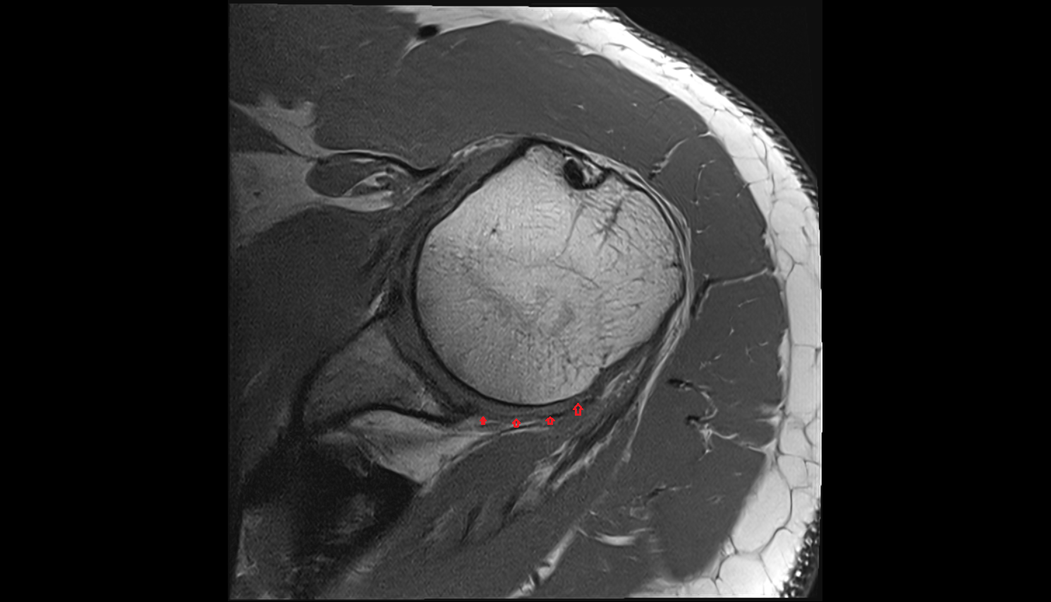 Inferior Glenohumeral Ligament Posterior band  axial cross sectional anatomy 3T MRI AI enhanced radiology image-img-00000-00000
