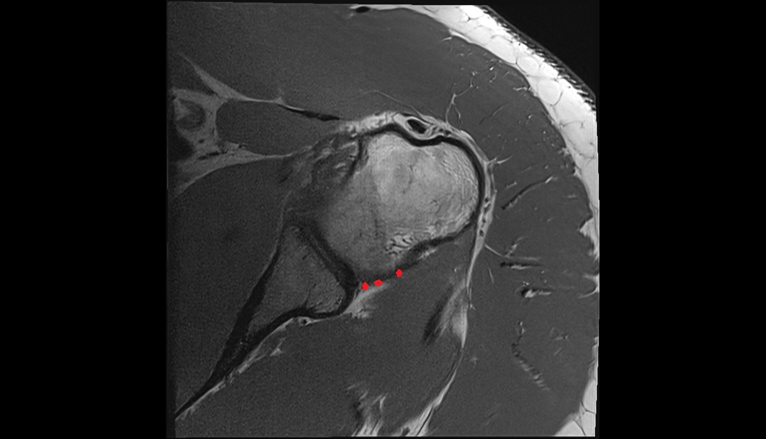 Inferior Glenohumeral Ligament Posterior band  axial cross sectional anatomy 3T MRI AI enhanced radiology image-img-00000-00000_00001