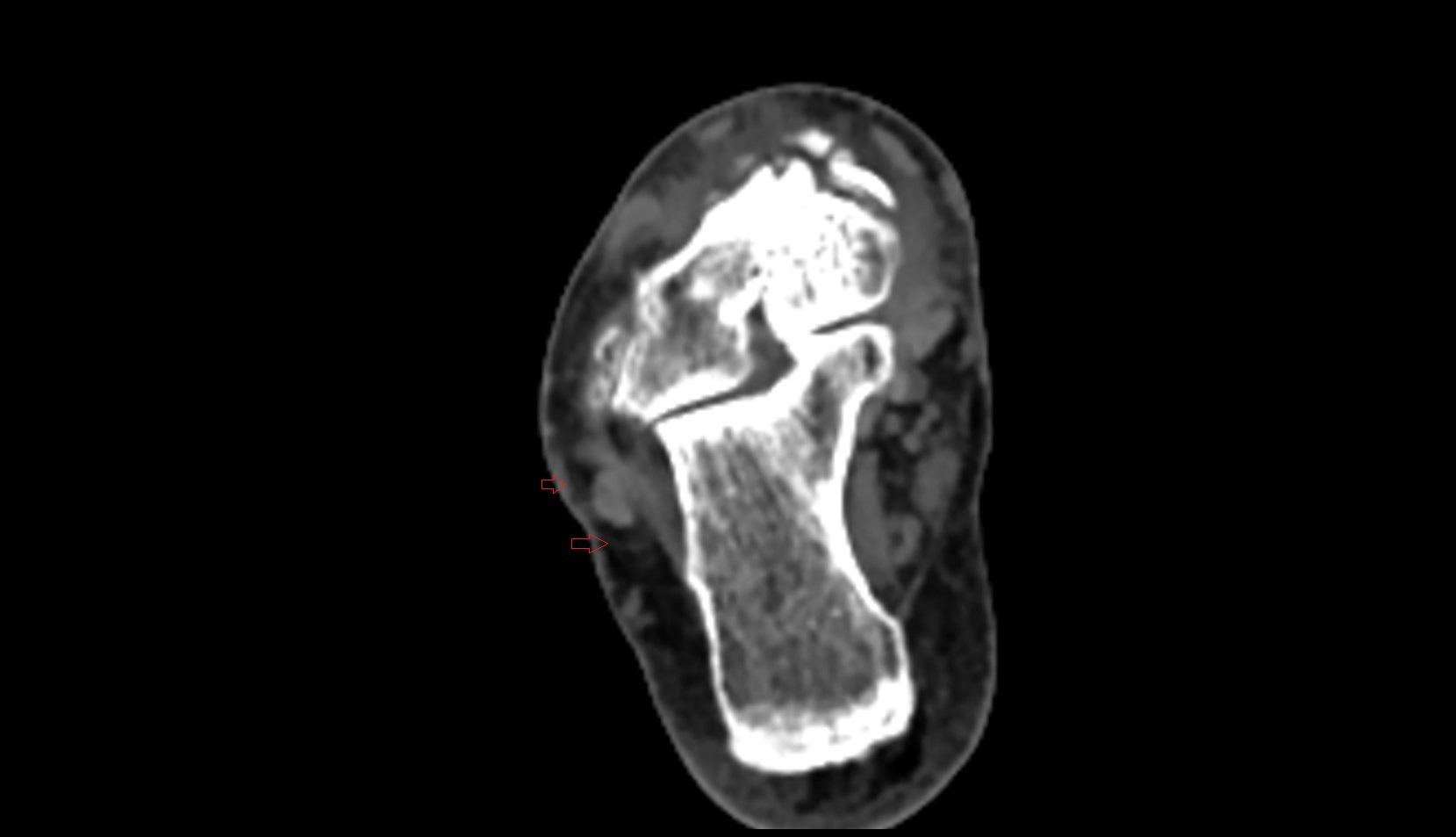 Inferior Peroneal (Fibular) Retinaculum ct axial