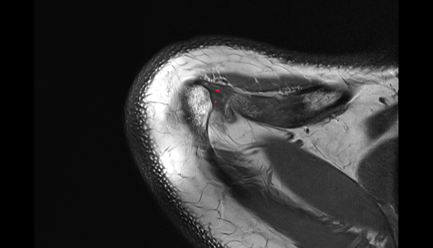 Inferior acromioclavicular ligament  axial cross sectional anatomy 3T MRI AI enhanced radiology image-img-00000-00000