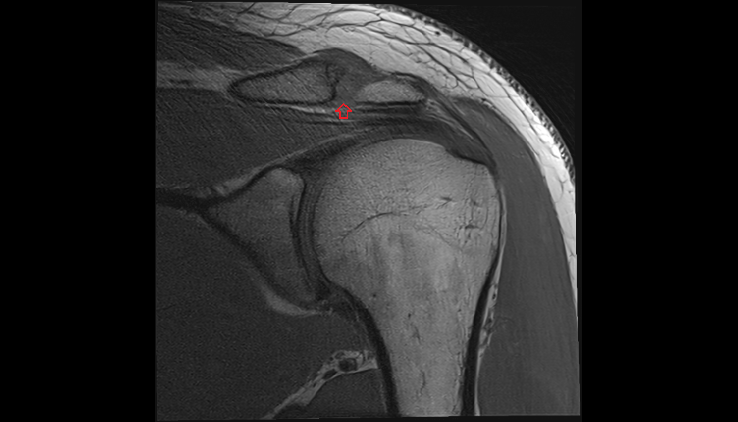 Inferior acromioclavicular ligament  coronal cross sectional anatomy 3T MRI AI enhanced radiology image-img-00000-00000