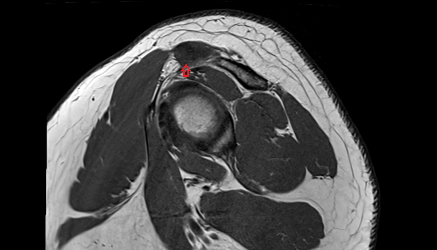 Inferior acromioclavicular ligament  sag cross sectional anatomy 3T MRI AI enhanced radiology image-img-00000-00000