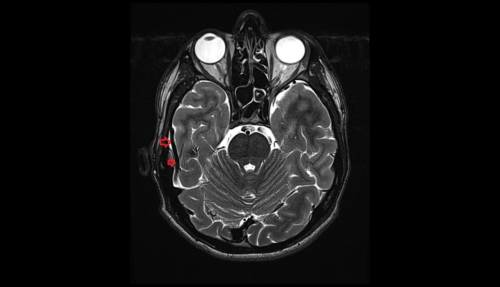 Inferior anastomotic vein (Labbé) MRI 3T axiall image