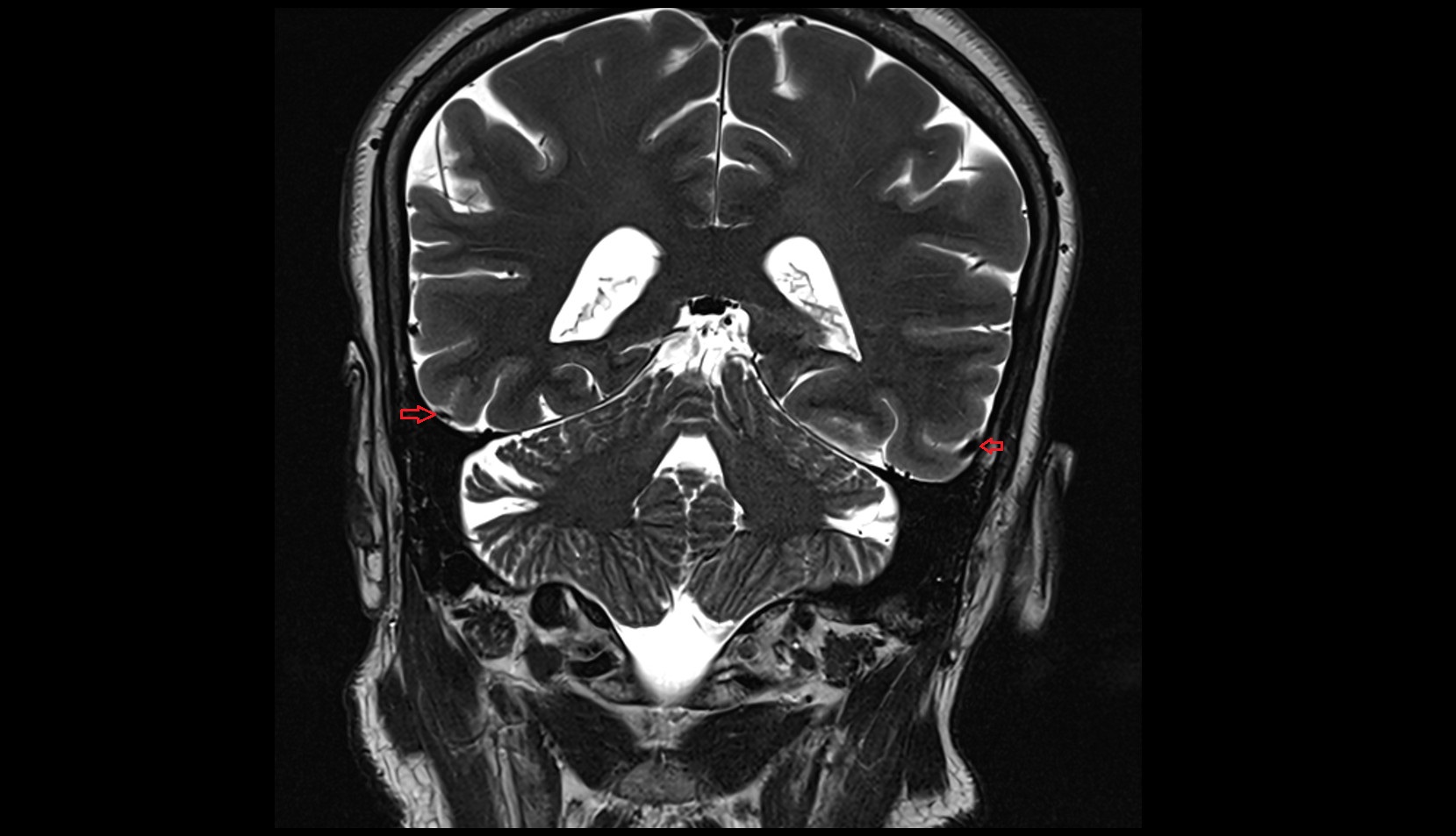 Inferior anastomotic vein (Labbé) MRI 3T coronal image