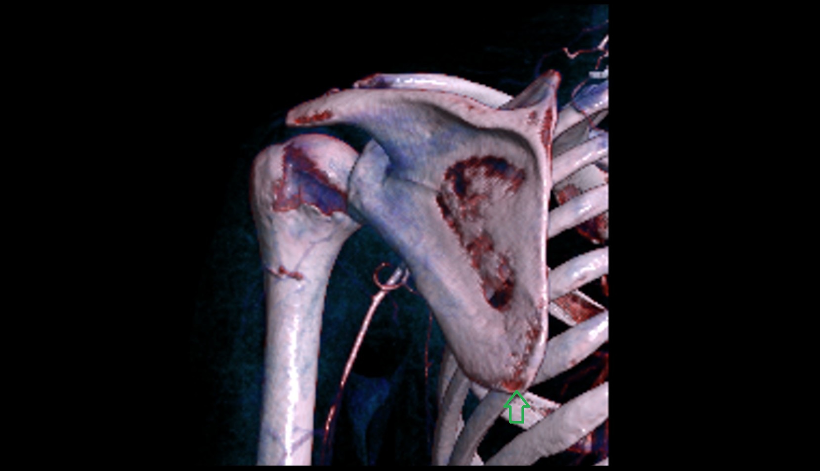 Inferior angle of scapula
