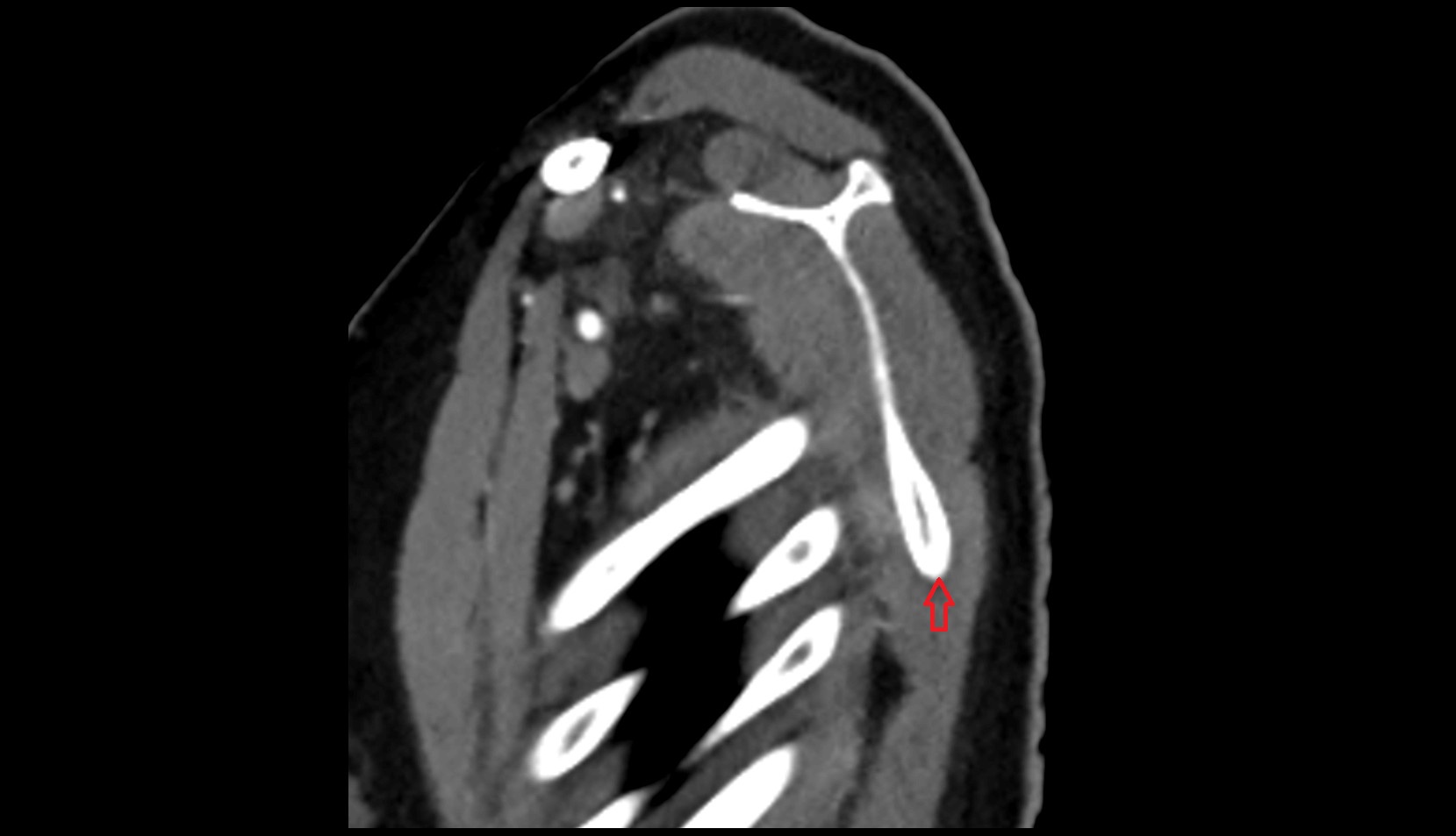 Inferior angle of scapula ct