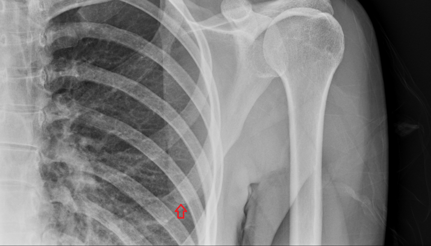 Inferior angle of scapula x ray anatomy labelled image-img-00000-00000